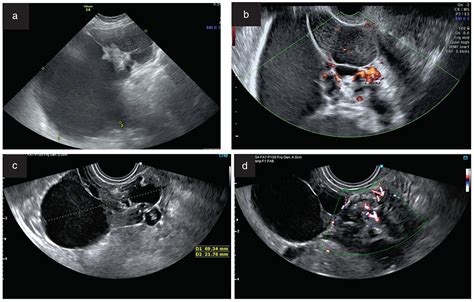 Imaging In Gynecological Disease 24 Clinical And Ultrasound