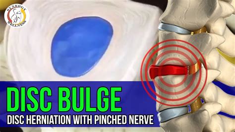 disc bulge disc herniation with pinched nerve watch in 3d youtube