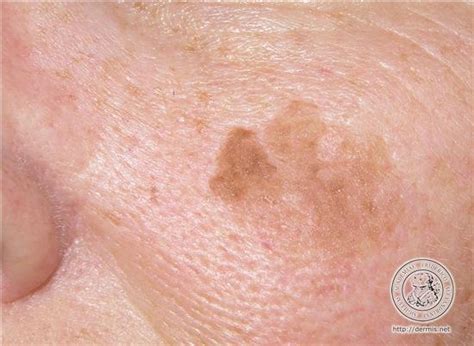 Keratosis Overgrowth And Thickening Of Skin Increases With Age
