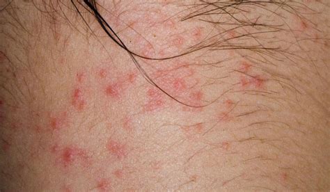 An Introduction To The Types Of Itchy Skin Rashes