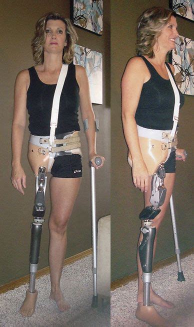 Pin By Scott Christiansen On Then And Know Prosthetic Leg Amputee Lady Orthotics And Prosthetics
