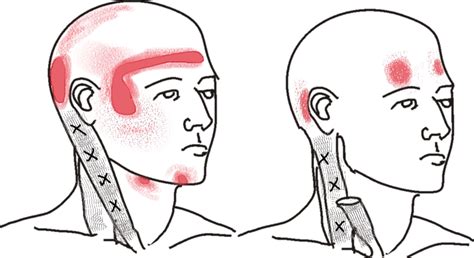 Headache Associated With Neck Pain ⋆ Physiosunit