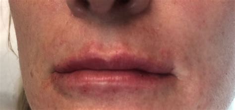 Connecticut Lip Rejuvenation Before And After Photos New Haven