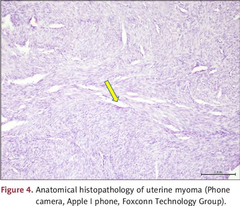 Figure 5 From Giant Fibroepithelial Polyps Of The Vulva In A Woman With