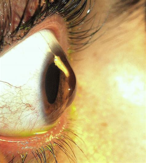 Keratoconus Causes Symptoms Contact Lenses Surgery Treatment