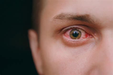 Prevention And Symptoms Of Eye Infection Shekar Eye Hospital