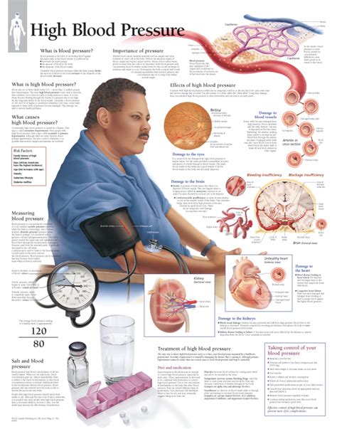 High Blood Pressure 1450 - Anatomical Parts & Charts