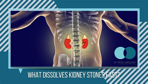 What Dissolves Kidney Stones Fast St Pete Urology