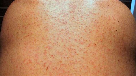 Maculopapular Rash Causes Treatment And More
