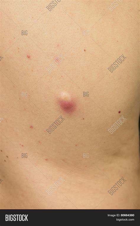Infected Sebaceous Cyst Image And Stock Photo 80664380