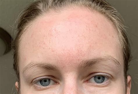Skin Concerns I Have Been Treating My Forehead Like Fungal Acne For