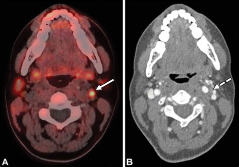 Contemporary Multimodality Imaging Of Primary Hyperparathyroidism