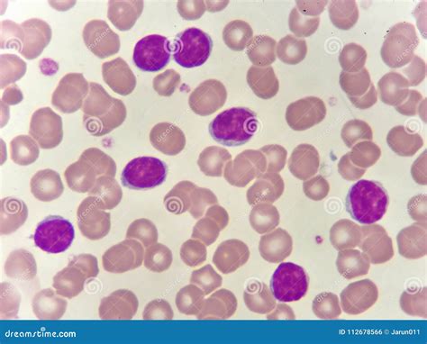 Leukemia Cells In Blood Smear Stock Photo Image Of Blood Microscopen