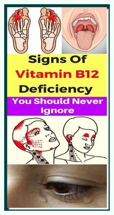 5 Warning Signs Of Vitamin B12 Deficiency You Should Never Ignore Artofit