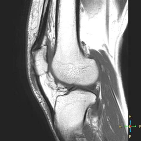 Spontaneous Osteonecrosis Of The Knee Sonk Radiology Case
