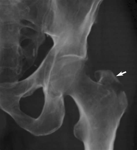 Fractures And Dislocations Of The Femur Anesthesia Key