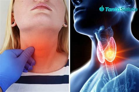 Hyperthyroidism A Pathology With A Strong Impact On Our Body Causes