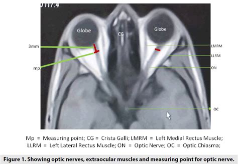 Magnetic Resonance Imaging Nomogram For Optic Nerve And Extraocul