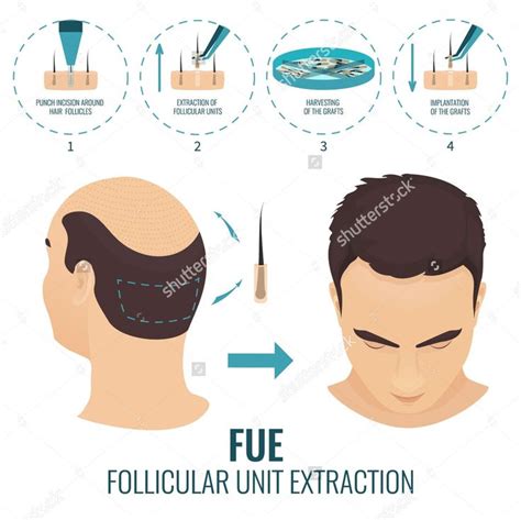 Facts About Hair Transplant Surgery Procedure Risks And Care Hair