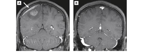 A Baseline Gadolinium Enhanced T1 Weighted Magnetic Resonance Imaging