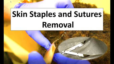 How To Remove Skin Staples And Sutures Youtube