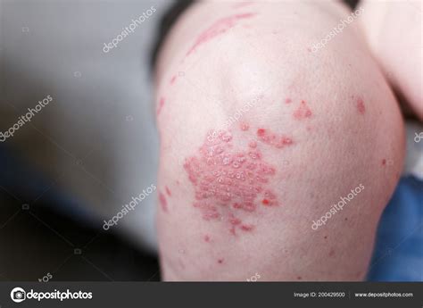 Allergic Rash Dermatitis Eczema Skin On Leg Of Patient Psoriasis And