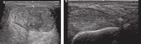 A And B A Transverse View Of Achilles Enthesitis Showing Thickened