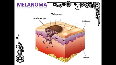 Skin Cancer 4nu02 Youtube