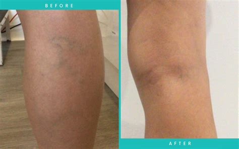 Varicose Vein Removal With Foam Sclerotherapy Lasaderm