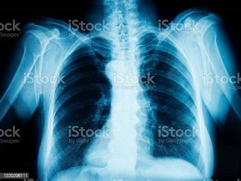 Chest Xray Stock Photo Download Image Now X Ray Image Chest