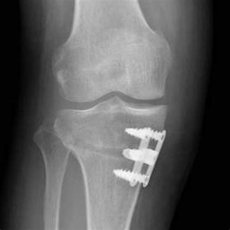 The Complications Of High Tibial Osteotomy Bone And Joint