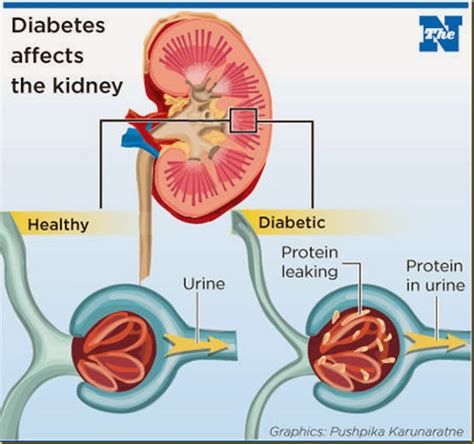 Chronic Kidney Disease Definition Causes Symptoms Staging