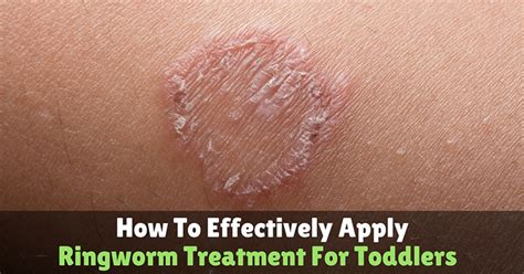 How To Effectively Apply Ringworm Treatment For Toddlers