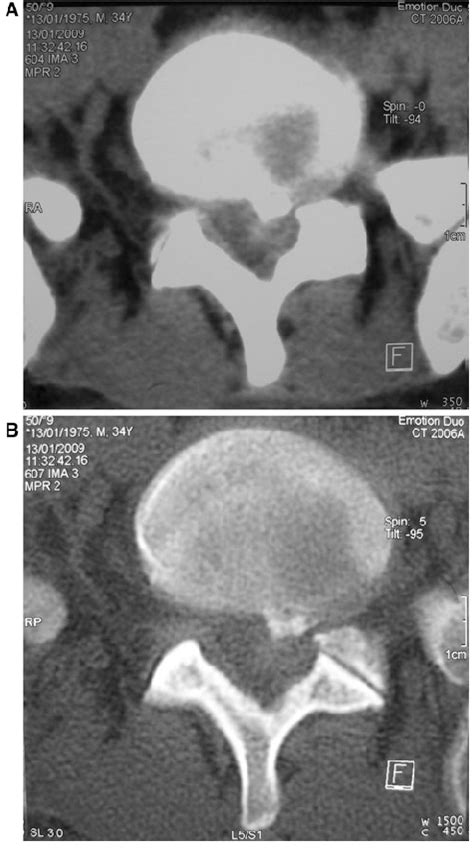 Axial Lumbar Spinal Ct Scan Parenchymatous A And Bone Windows B