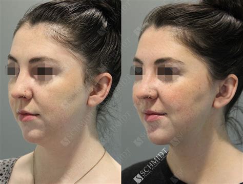 5321 Schmidt Facial Plastic Surgery
