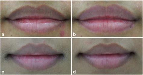 The Clinical Picture Of Hyperpigmented Lip At Baseline And The End Of