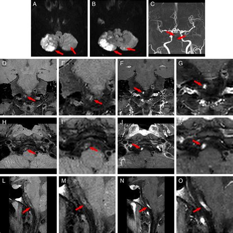 Representative Brain Mri Findings Of A Stroke Patient With Intracranial