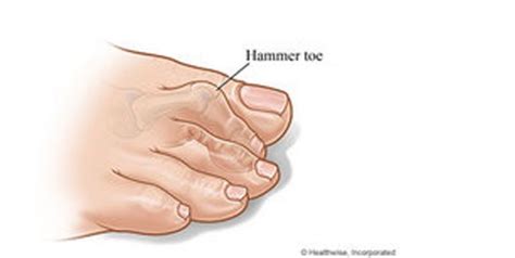 Hammer Toe 4 Life Podiatry