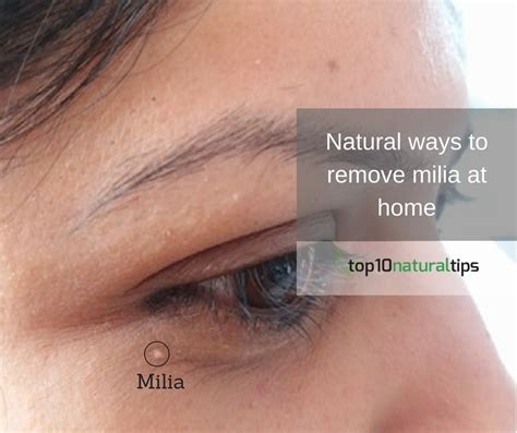 What Is Milia And How To Remove Milia At Home Top10 Natural Tips