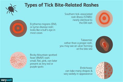 Tick Bite Signs Symptoms And Complications