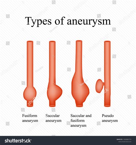Aneurysm Types Infographics Illustration Stock Illustration 1282885774