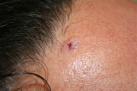 What Does Carcinoma Skin Cancer Types Basal Cell Carcinoma Bcc