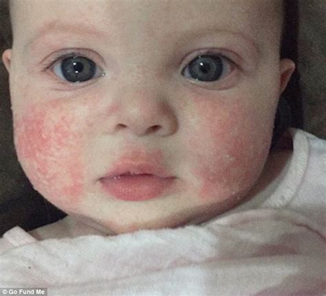 Brisbane Baby With Severe Eczema On Her Face Told Shell Have To Wait A