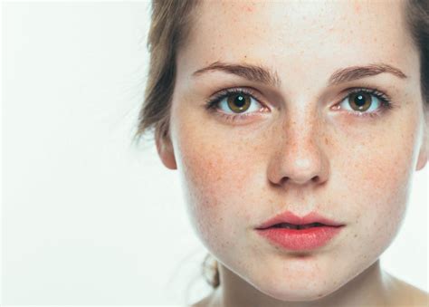 How To Get Rid Of Freckles The Beauty Beans