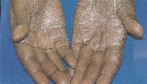 Skin Disorders In Elderly Persons Part 5 Fungal Infections Tinea