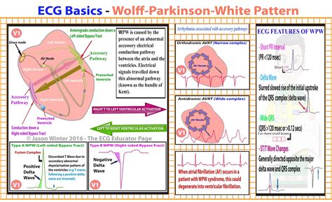 Psvt occurs because of a short circuit — an abnormal electrical pathway made of heart cells — that allows but because psvt is paroxysmal (occasional and sudden), an office ecg may look normal. ECG Educator Blog : Wolff-Parkinson-White