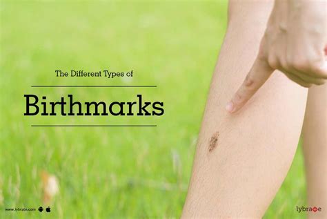 The Different Types Of Birthmarks By Dr Colanil Goyal Lybrate