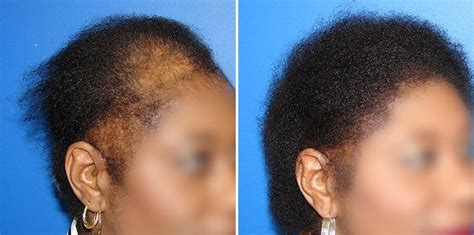 What Causes Baldness In Black Males Florida Noel