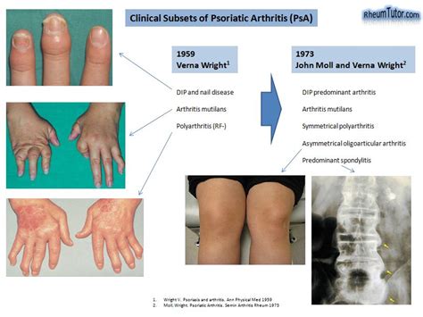 Psoriatic Arthritis · Rheumtutor