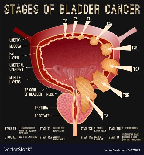 Bladder Cancer Stages Royalty Free Vector Image